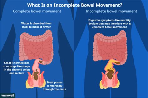 irritable <b>bowel</b> syndrome (IBS) inflammatory <b>bowel</b> disease - such as Crohn's disease. . Incomplete bowel movement wiping